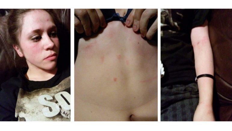 A police officer used a Taser on Tiara Helm while four others pinned her down after she had a seizure at a concert in Rainbow City, Ala. The photos above show marks on her face, torso, and arm from the encounter.