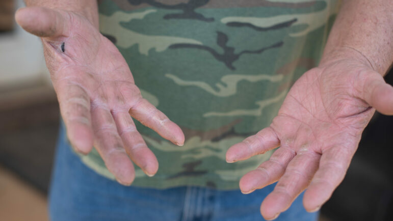 Rily Hughlett shows his calloused hands from years of working in coal mines.
